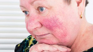 Hautpflege bei Rosacea