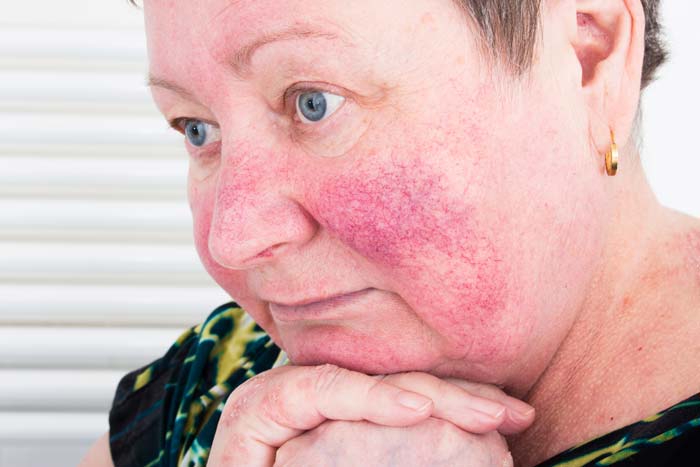 Hautpflege bei Rosacea