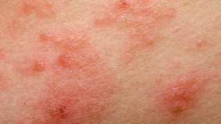 Neurodermitis